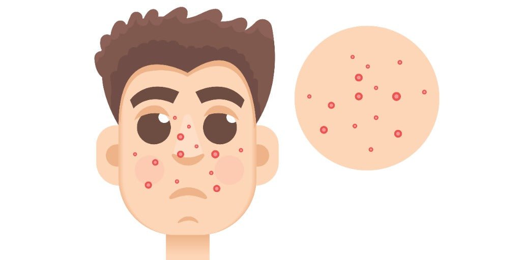 Understanding and Managing Acne: A Comprehensive Guide - Vmen's
