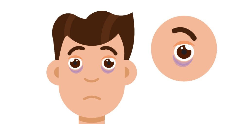 Understanding and Managing Dark Eye Circles: A Comprehensive Guide - Vmen's