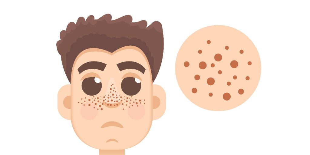 Hyperpigmentation in Men: Causes & Care | VMEN’S