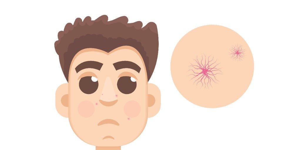 Rosacea in Men: Signs & Gentle Skincare | VMEN’S